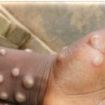 美國7州新發現9起猴痘病例  世衛呼籲各國加強監測
